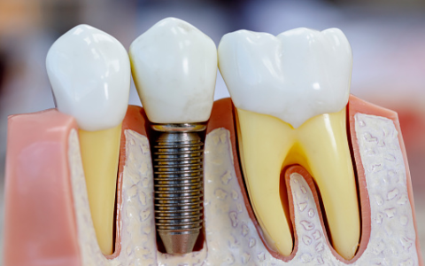 Mẹo tiết kiệm chi phí mà vẫn đảm bảo chất lượng trồng răng Implant