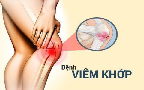 Bệnh viêm khớp gối và giải pháp cải thiện hiệu quả nhờ sản phẩm thảo dược